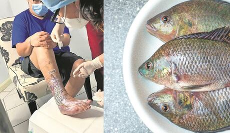 Piel de tilapia para curar el pie diabético, en la Universidad Autónoma de Querétaro 
