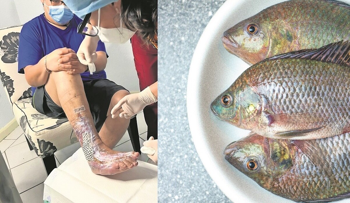 Piel de tilapia para curar el pie diabético, en la Universidad Autónoma de Querétaro