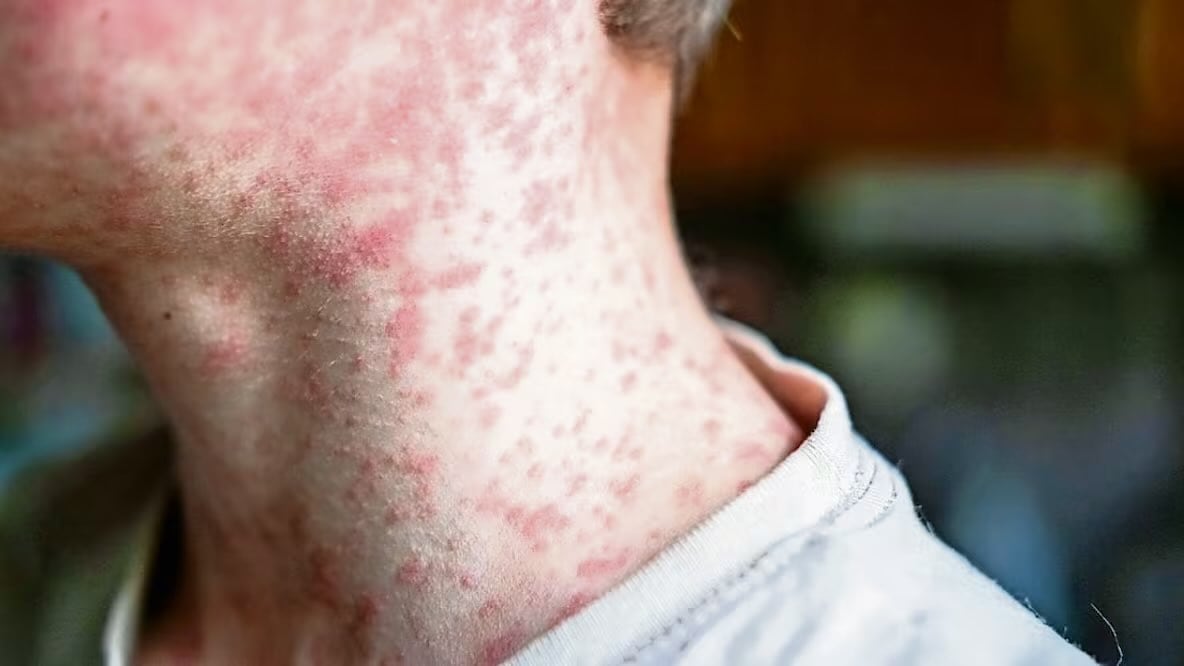 Contra esta enfermedad hay una sola médica eficaz: vacunarse. Foto: Especial