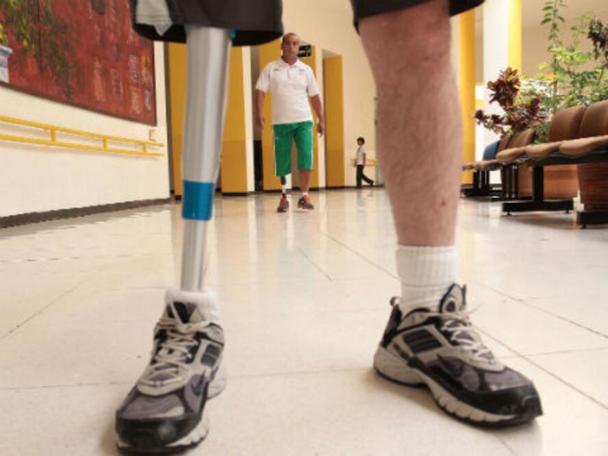 Primera prótesis mioeléctrica en Qro