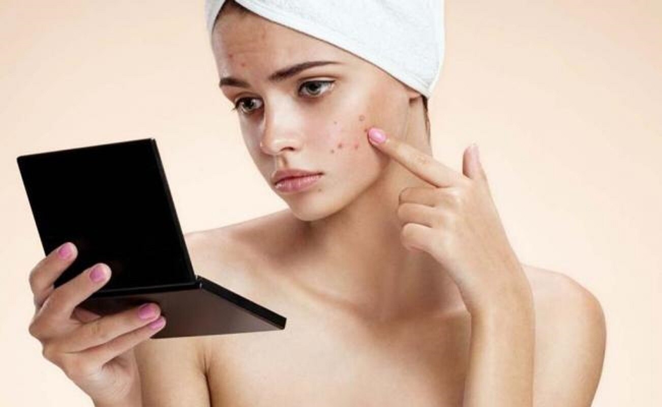 Seis remedios caseros contra el acné que jamás debes emplear