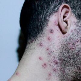 Hombre da positivo a la viruela del mono en Querétaro; es el segundo caso 