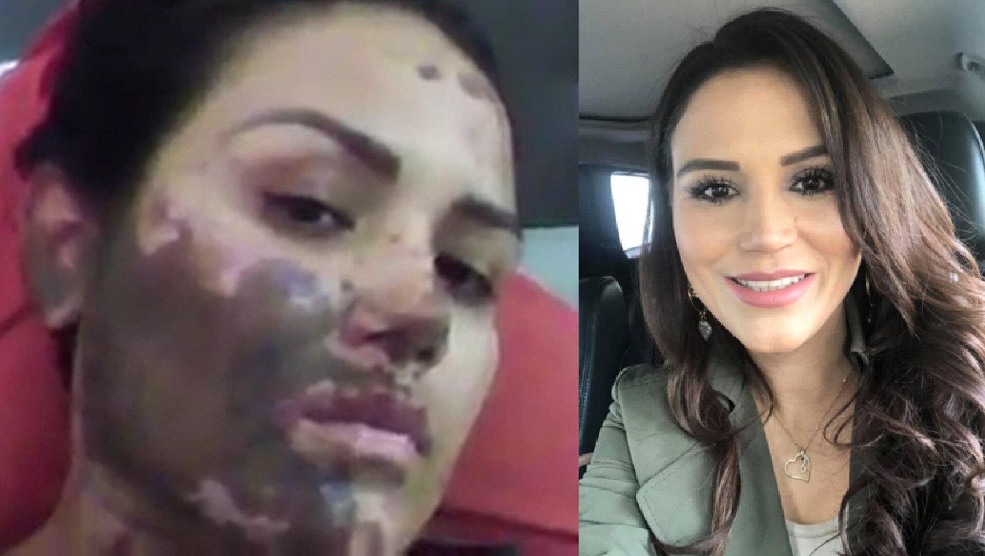 Gloria pide justicia. La agredieron con ácido en Querétaro