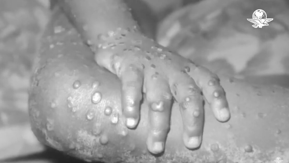 Secretaría de Salud confirma 386 casos de viruela del mono