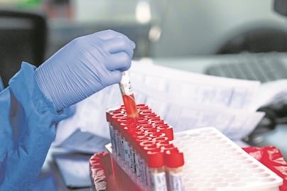 Confirman 13 contagios de viruela símica en Querétaro 