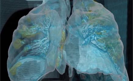 Así se ve el daño del Covid-19 en los pulmones