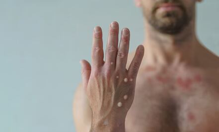 Detectan en Francia primer caso de la nueva variante de mpox; autoridades investigan origen del contagio