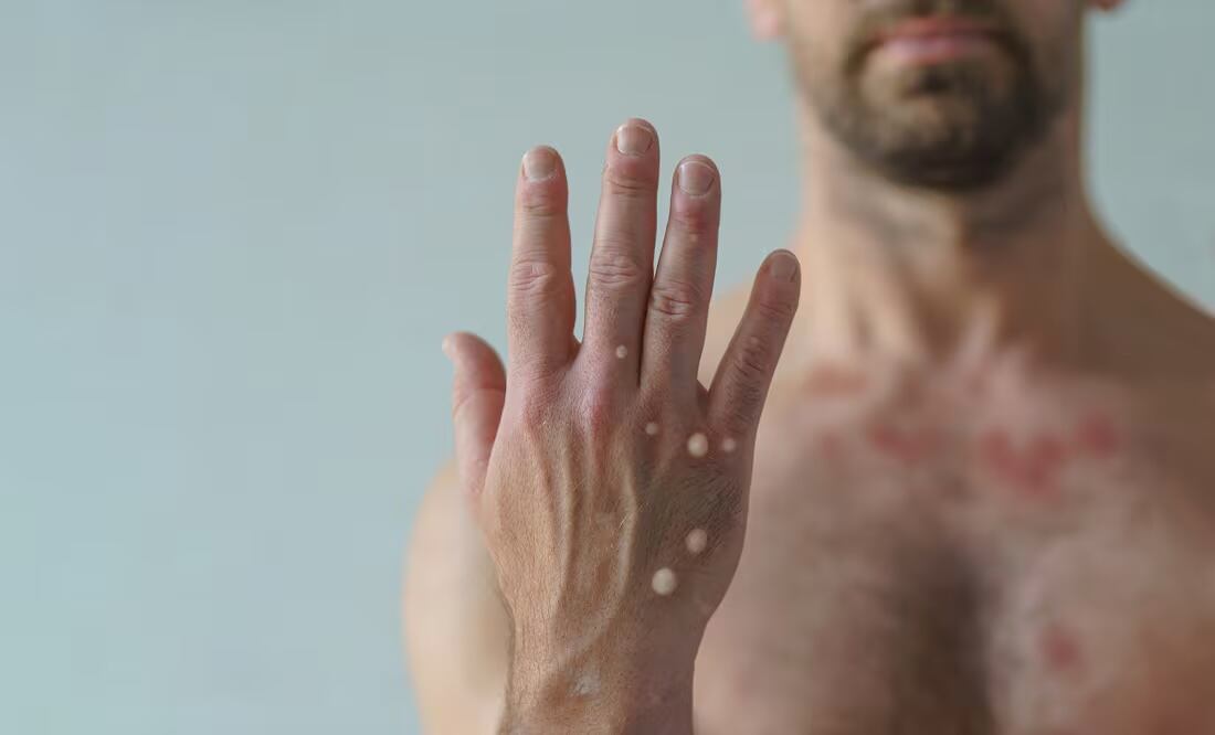 La mpox se caracteriza por lesiones cutáneas, como pústulas, fiebre alta y dolores musculares. Foto: Archivo/El Universal