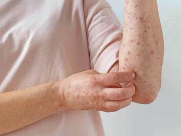 Vigilancia continua en Querétaro por viruela símica