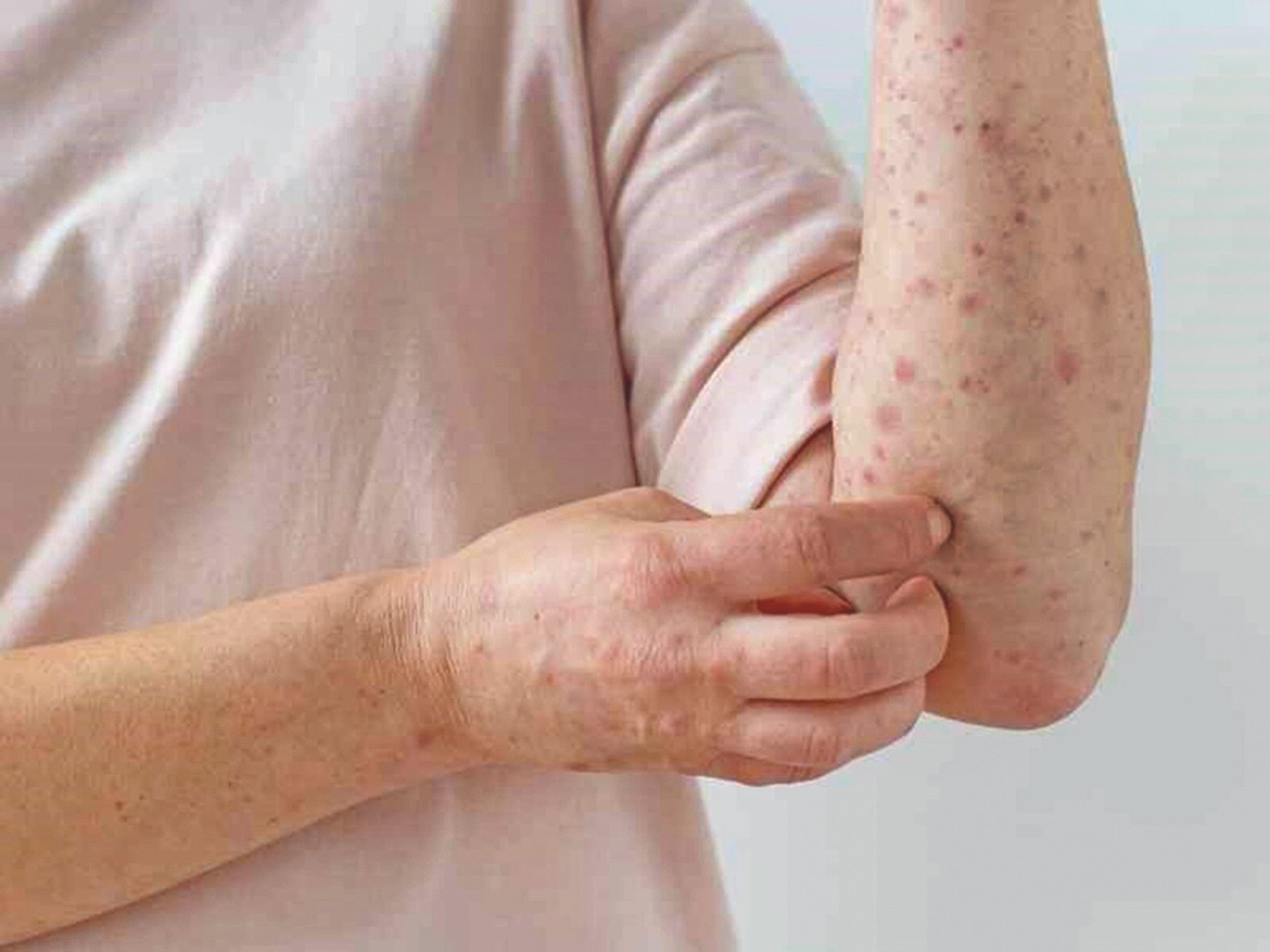 Vigilancia continua en Querétaro por viruela símica