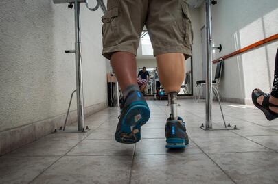 Diabetes, causa principal de amputaciones: especialista 