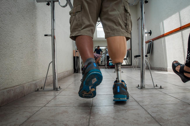 Diabetes, causa principal de amputaciones: especialista