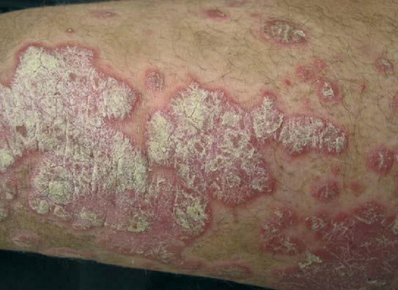 2% de la población padece psoriasis