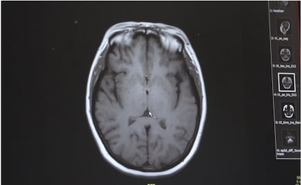 Alertan por ameba “comecerebros” en ocho ciudades de Texas