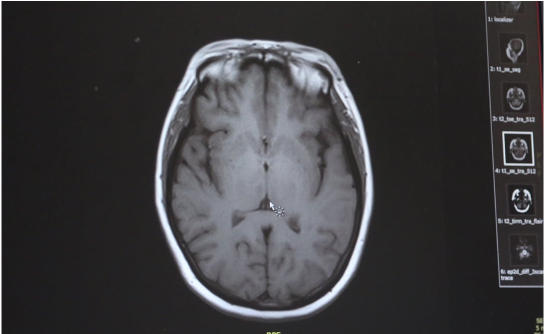 Alertan por ameba “comecerebros” en ocho ciudades de Texas