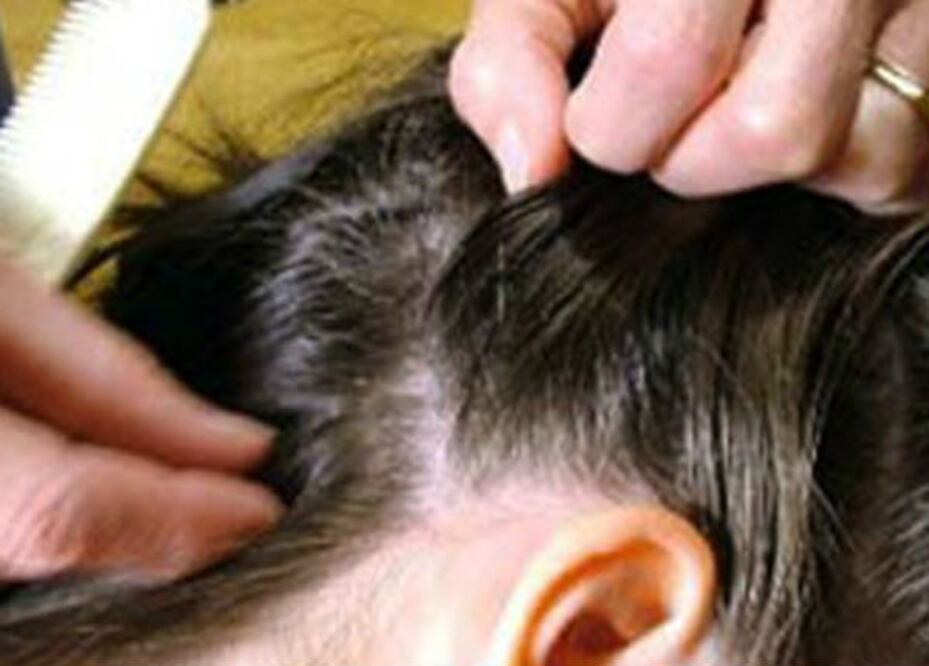 Buscan prevenir la pediculosis
