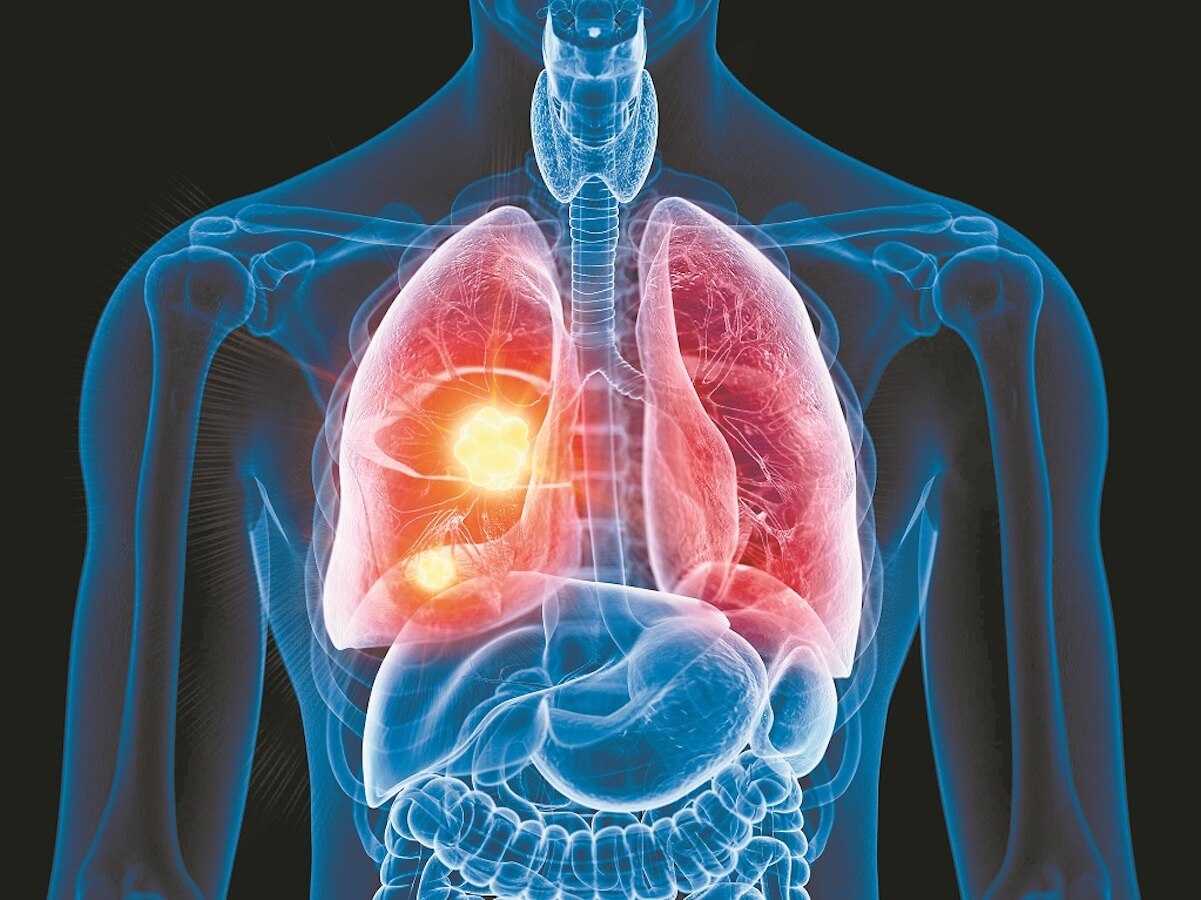 Cáncer de pulmón cuesta 1 millón de pesos, al año, en Querétaro