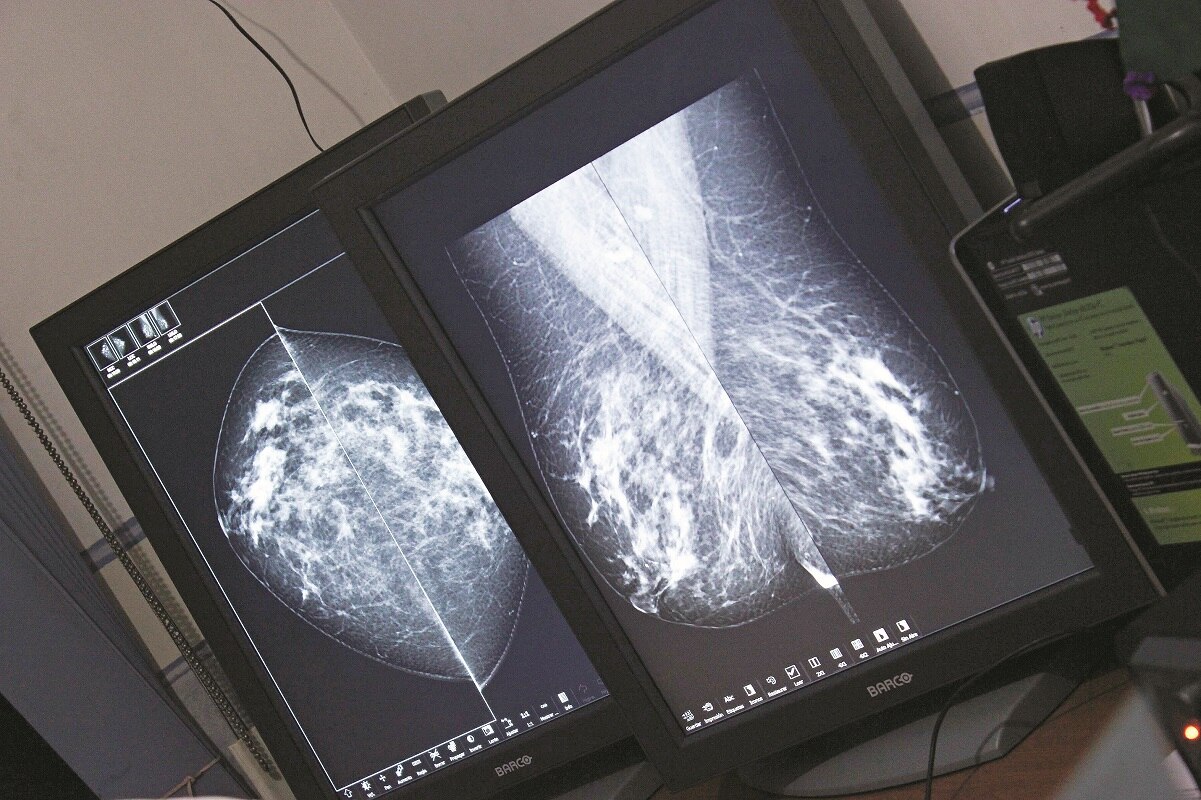 El cáncer de mama no se puede prevenir, alertan en Querétaro