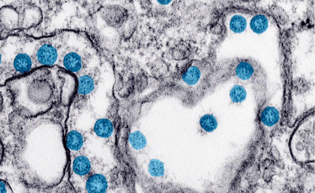 Coronavirus: Este fármaco reduce el riesgo de Covid-19 en un 57%, dice estudio